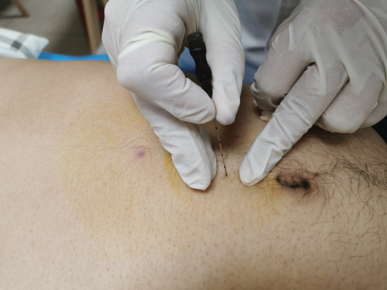 pga线是什么线浅谈穴位埋线2024-05-31 09：36：00   来源：     作者：  点击：_https://www.jmylbn.com_新闻资讯_第1张