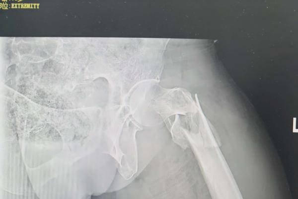 凶险的老年髋部伤：全面读懂股骨转子间骨折